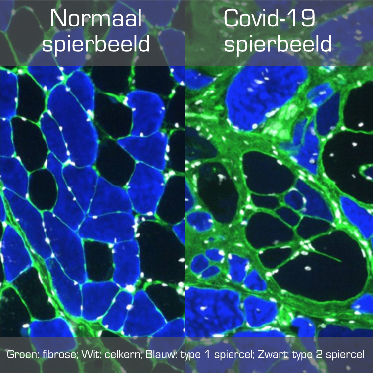 Covid en Non Covid spierbeeld